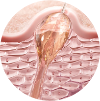 Skin mechanism